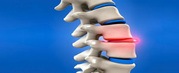 Chiropractic Treatment for a Slipped Disc